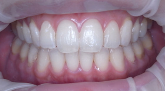 こちらはインビザライン矯正の後にホワイトニングを行なった患者さまです。歯並びの美しさと白さを同時に実現しました。